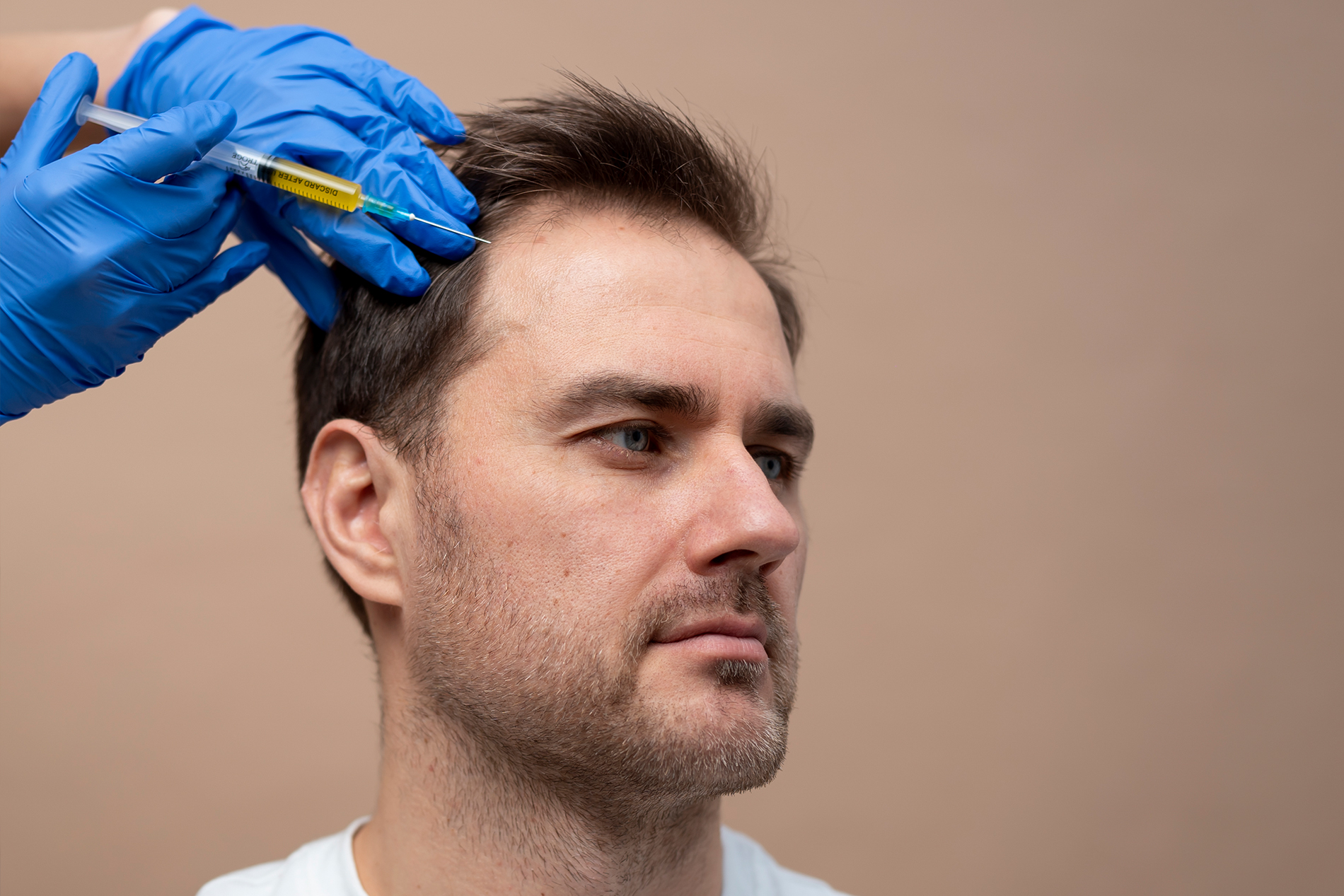 Hair-Transplant-PRP1