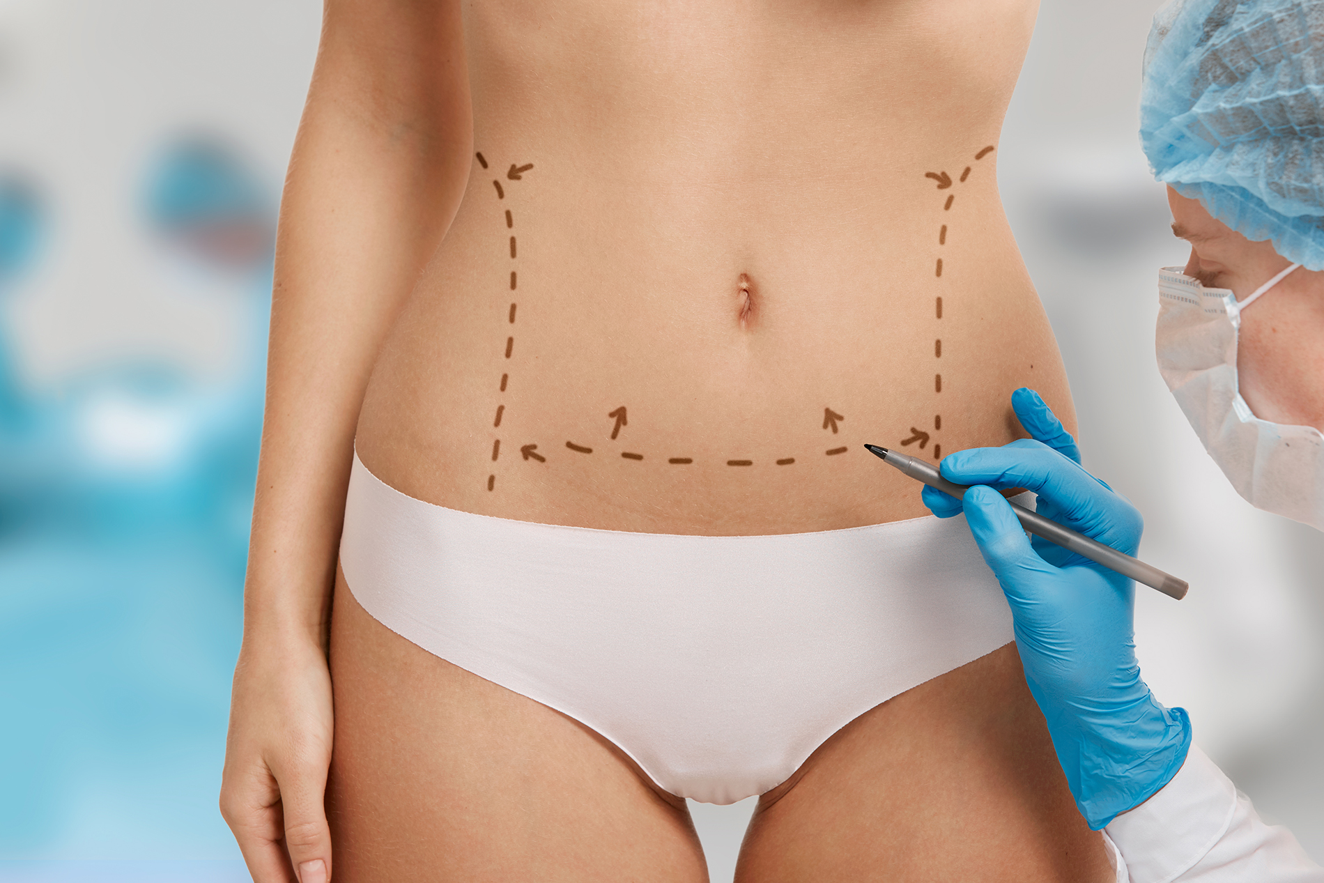 Tummy-Tuck-Liposuction1